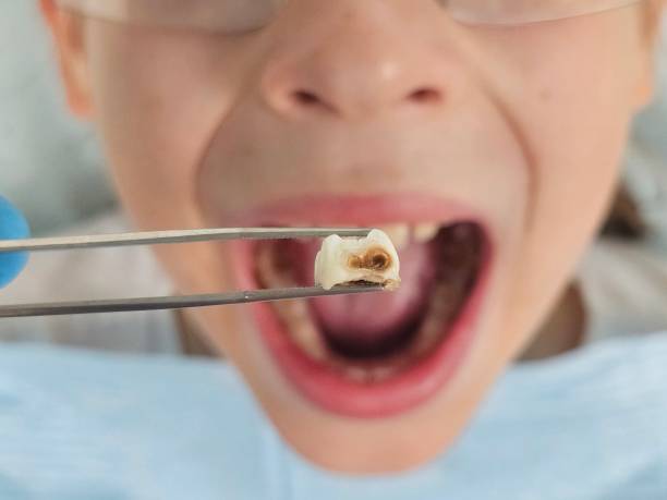Best Emergency Wisdom Tooth Extraction in Malaga, NJ
